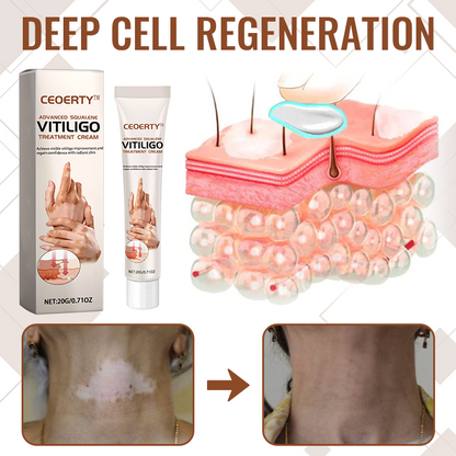Ceoerty™ Advanced Squalene Vitiligo Treatment Cream